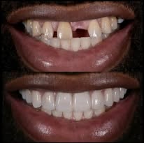 Prothèse dentaire - Cas 6